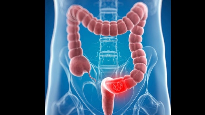 CampaÃ±a contra CÃ¡ncer colorrectal quita la vida a 700 personas en la Isla anualmente