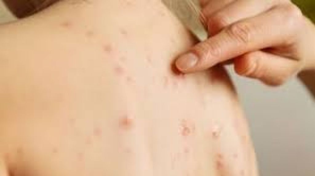  Vea video: Filipinas declara un brote de sarampi&oacute;n con m&aacute;s de un millar de casos 