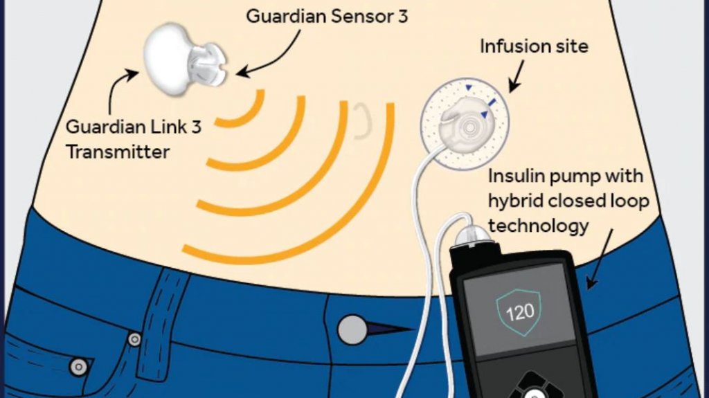  La Isla produce el nuevo sistema de bomba de insulina Minimed 770G de Medtronic aprobado por la FDA 