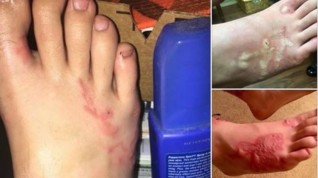  Tras visitar playa del sur de la Florida, adolescente contrae grave enfermedad 