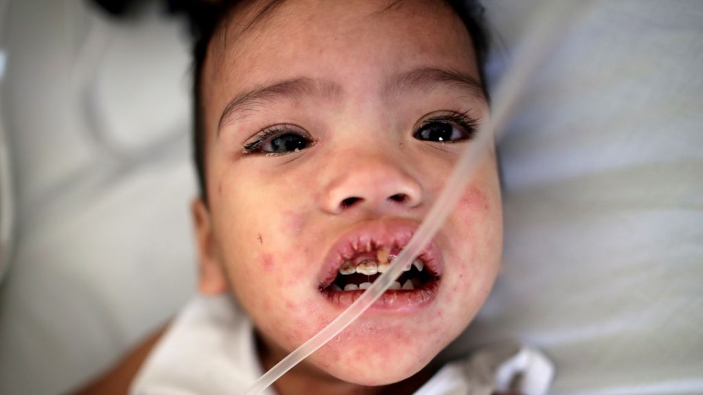  Autoridades de Nueva York podr&iacute;an cerrar escuelas por el brote de sarampi&oacute;n 