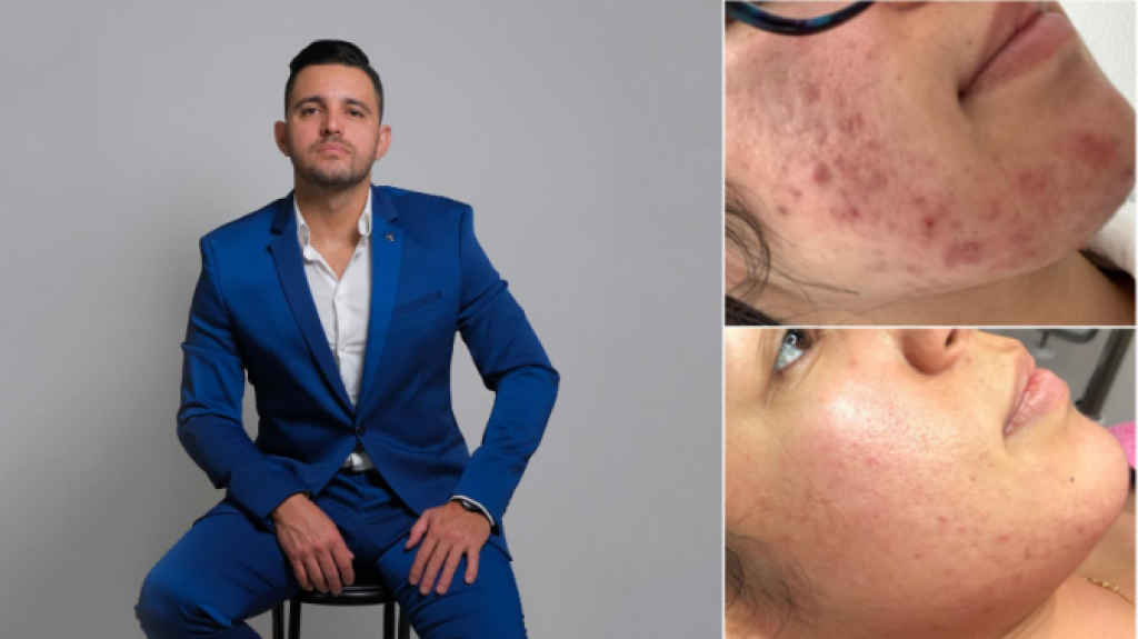  Experto entrega recomendaciones a personas con acné que tienen problemas con el uso de mascarillas 