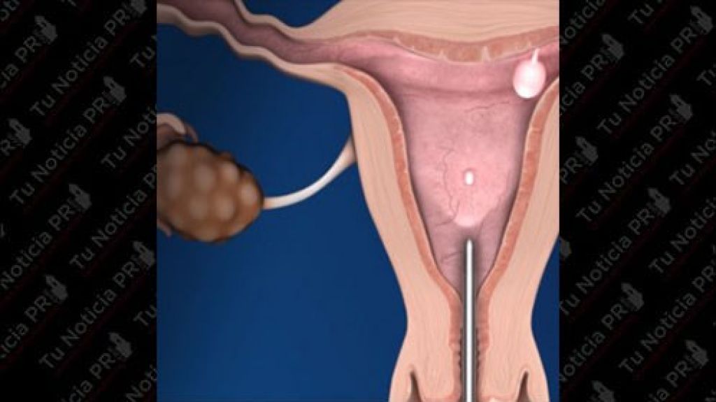  Novedoso tratamiento m&iacute;nimamente invasivo para tratar el sangrado uterino anormal 