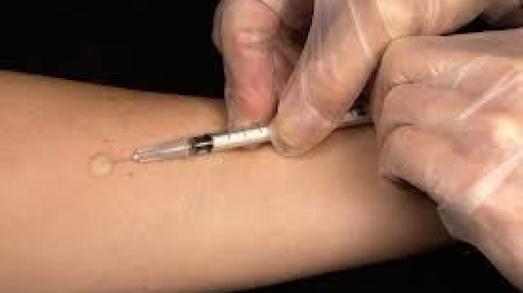  Salud adopta alternativas ante escasez medicamento para prueba de tuberculina 