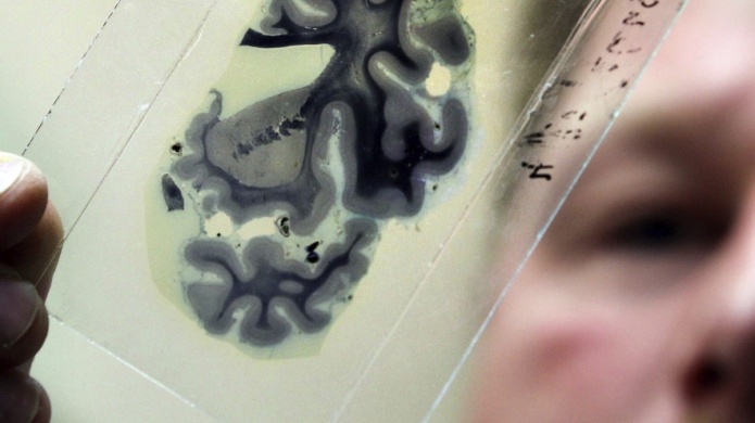 Nuevo descubrimiento puede ayudar a revertir pÃ©rdida de memoria en Alzheimer