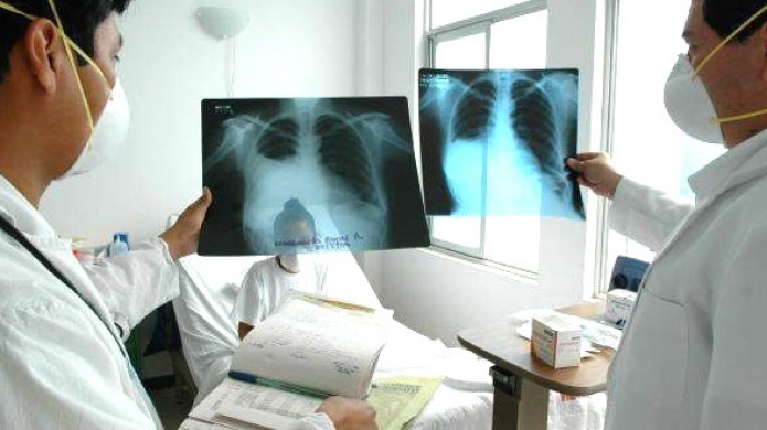 La OMS alerta sobre las muertes por la tuberculosis