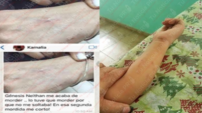 Maestra en Corozal muerde a un estudiante y luego le envía por texto las fotos a la madre 