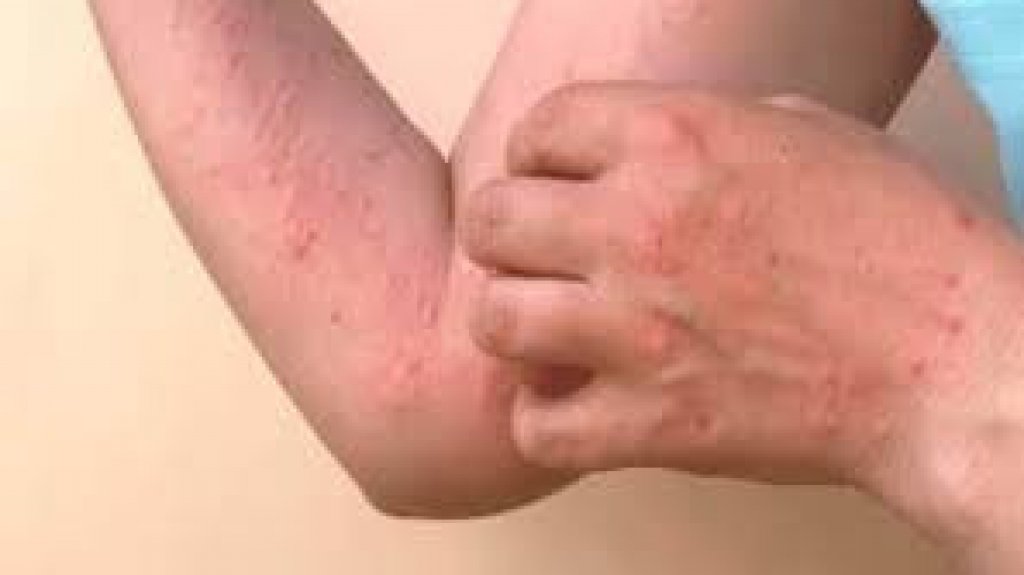  114 casos de viruela símica en informe de DS 