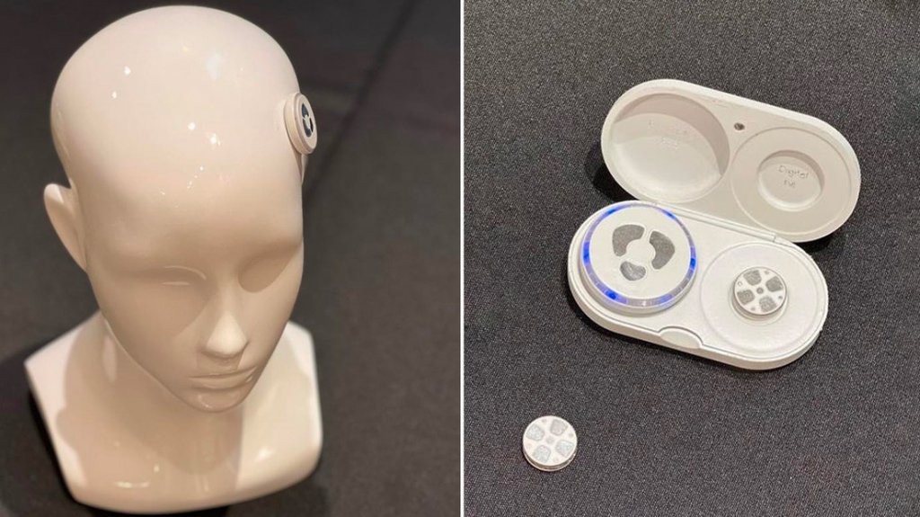  Presentan un innovador implante que “sin penetrar en el cerebro“ promete curar la depresión 