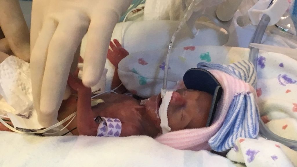NiÃ±a que pesÃ³ al nacer solo 13 onzas deja el hospital despuÃ©s de cuatro meses
