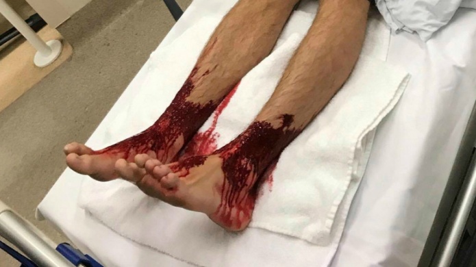 ¿Podrían ser las "pulgas marinas" responsables de estas picaduras?