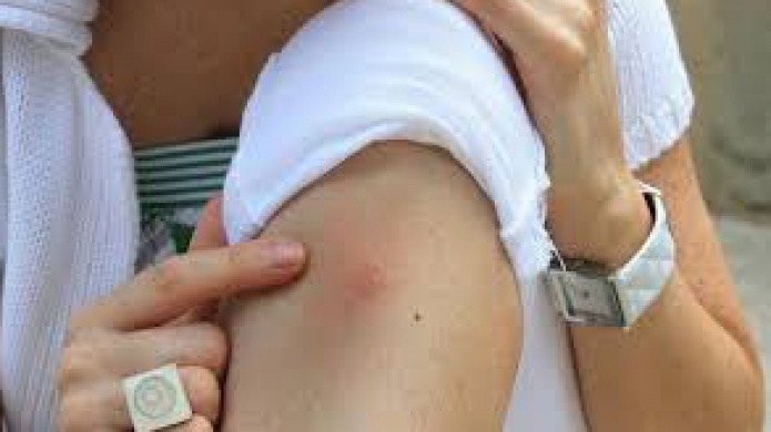 CONFIRMAN PRIMER CASO DE EMBARAZADA CON EL VIRUS  DE ZIKA