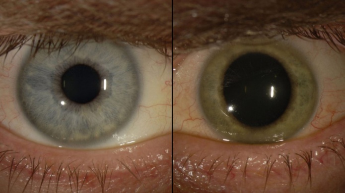 MÃ©dico declarado libre de Ã©bola encuentra el virus en sus ojos