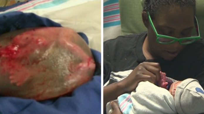 Caso de bebÃ© que naciÃ³ dentro del saco amniÃ³tico sorprende a mÃ©dicos