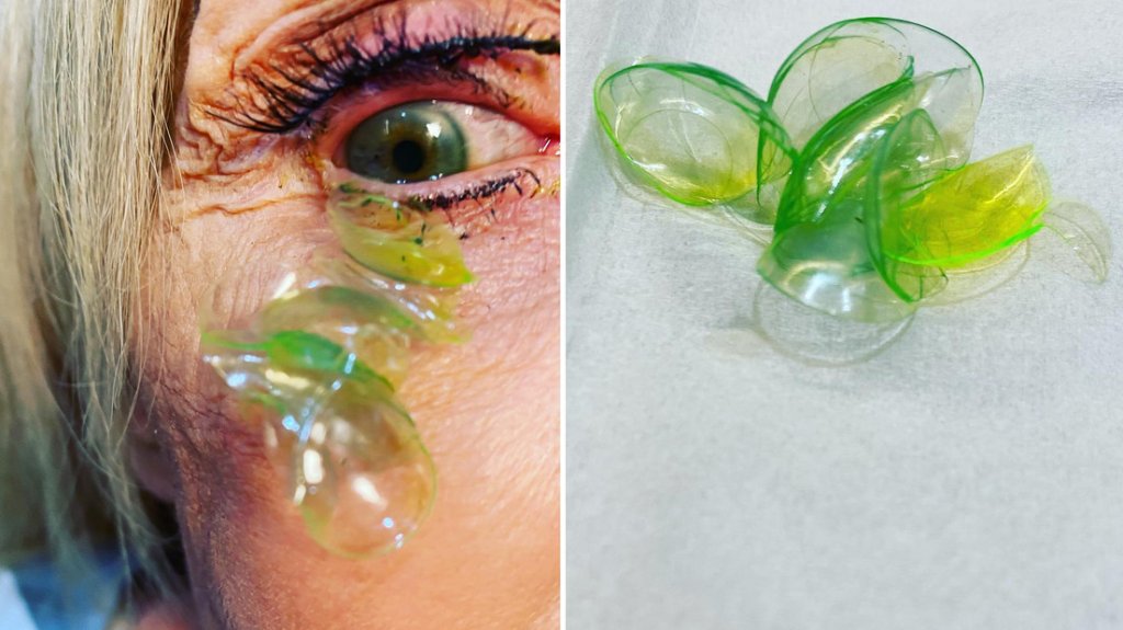  VIDEO:Una oftalmóloga remueve 23 lentes de contacto alojados en el ojo de una anciana 