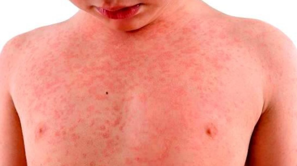  Infectóloga alerta sobre aparición en el país del “síndrome Kawasaki”, enfermedad que estaría asociada al Covid-19 