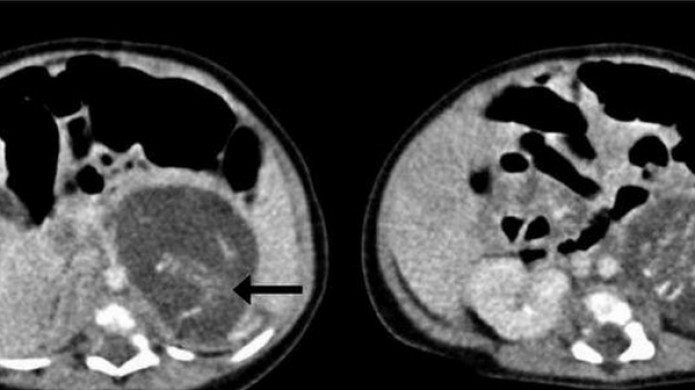 La niña que nació con fetos de gemelos en su vientre sorprende a los científicos