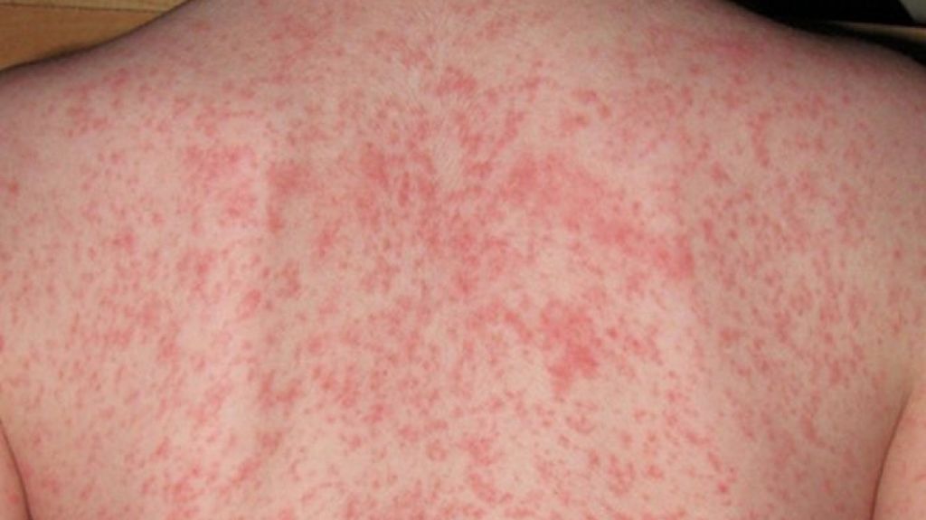  Salud informa que no se han reportado casos de sarampi&oacute;n com&uacute;n en Puerto Rico 