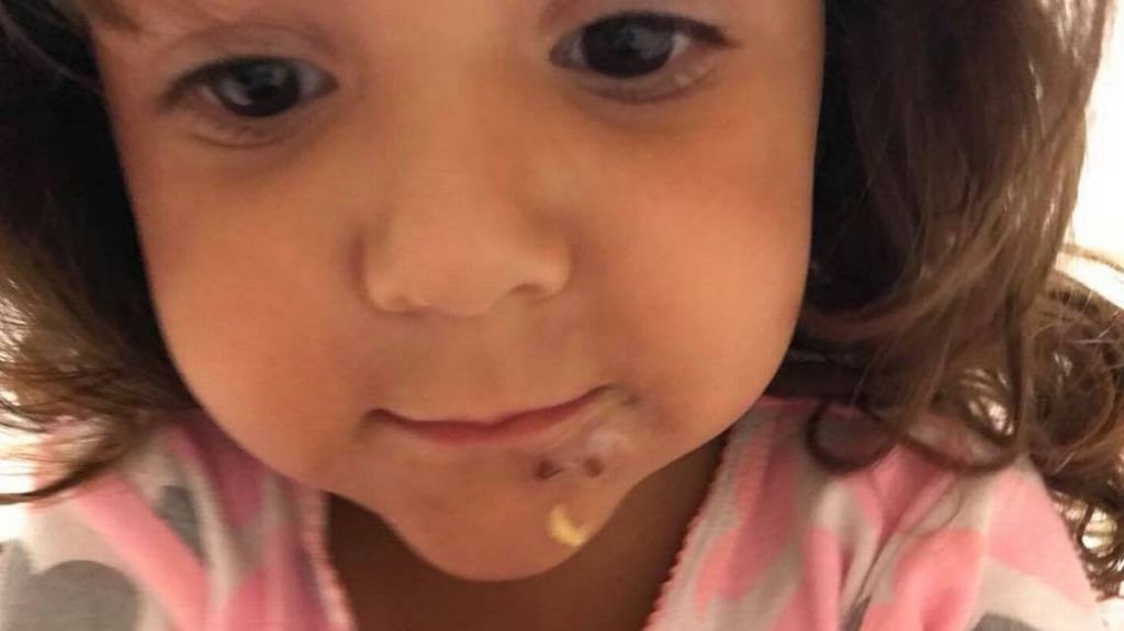  Ni&ntilde;a contrae infecciones tras fiesta de cumplea&ntilde;os en playa de Miami 