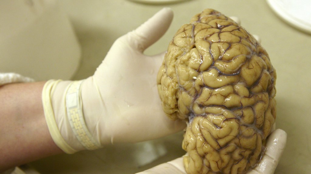  Un misterioso trastorno cerebral desconcierta a los médicos canadienses 