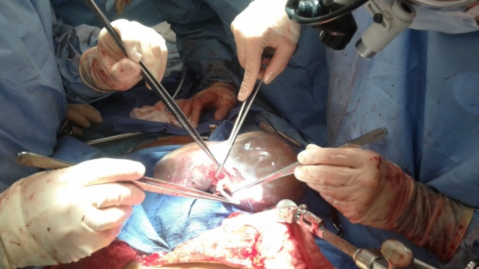 Senado de Puerto Rico investigarÃ¡ si hay brote de la bacteria Acinetobacter baumannii