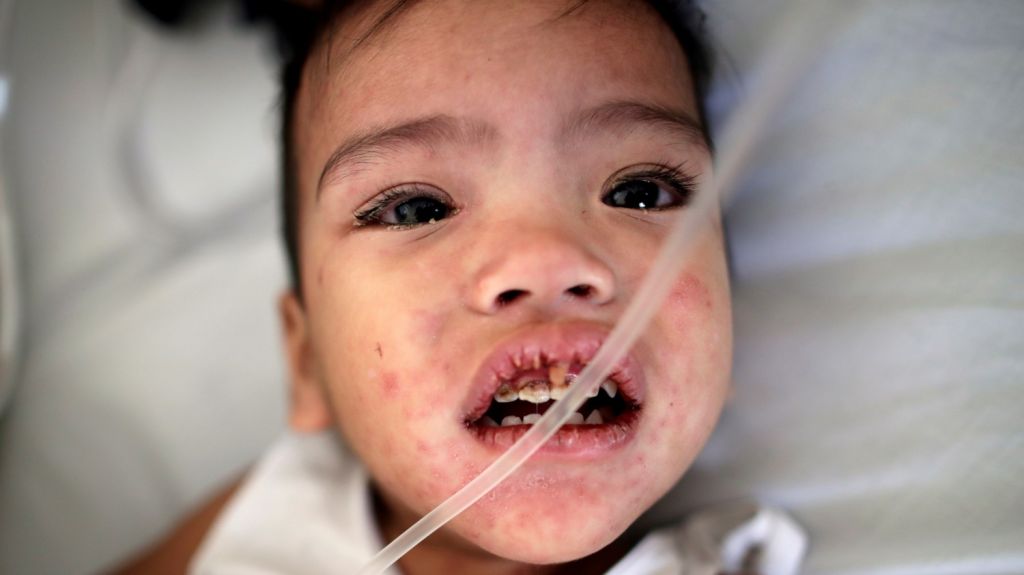  Los casos de sarampi&oacute;n suben este a&ntilde;o en EE.UU. y se encaminan a un r&eacute;cord 