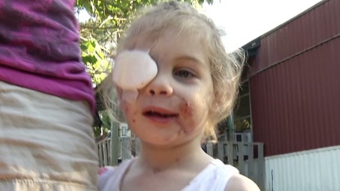 Restaurante de KFC acusado de expulsar a una niña desfigurada por un ataque de perro